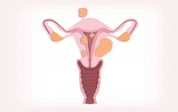 Especialista em Mioma Uterino SP